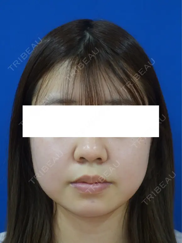 鼻尖縮小 before画像 メイン用