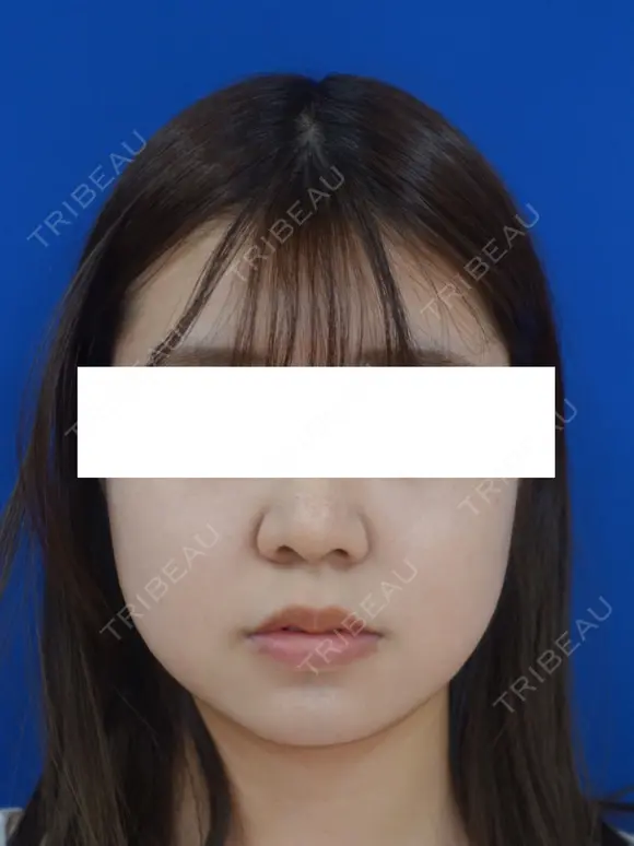 鼻尖縮小 30日後 メイン用
