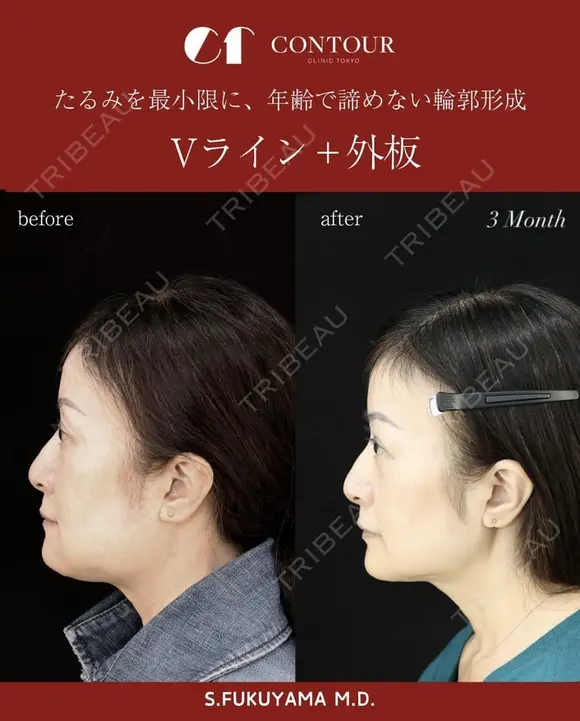 【輪郭整形】Vライン＋外板切除　たるみを最小限に、年齢で諦めない輪郭形成 90日後 メイン用