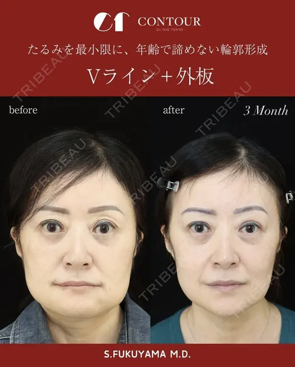 【輪郭整形】Vライン＋外板切除　たるみを最小限に、年齢で諦めない輪郭形成 before画像 メイン用