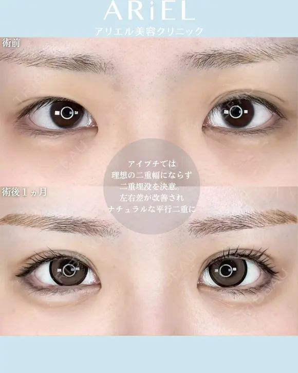 アリエルクイックループトリプル二重埋没法 before画像 メイン用