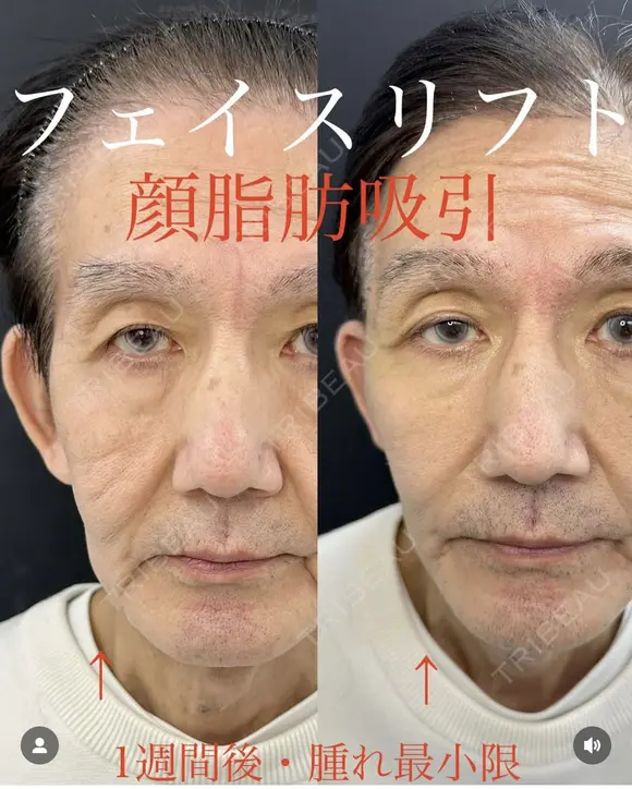 フェイスリフト＋顔脂肪吸引 after画像 メイン用
