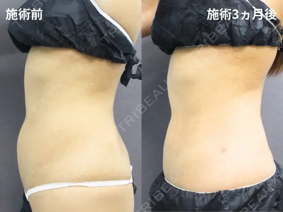 お腹の脂肪吸引 after画像 メイン用