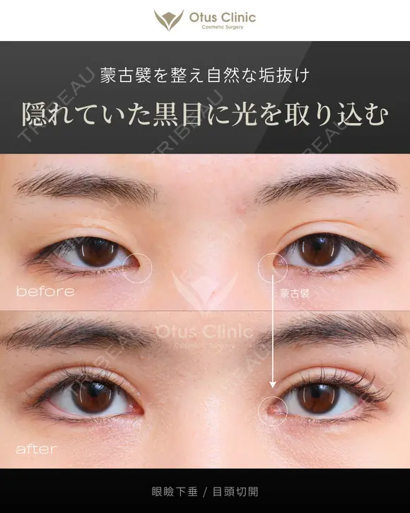 眼瞼下垂 / 目頭切開 180日後 メイン用
