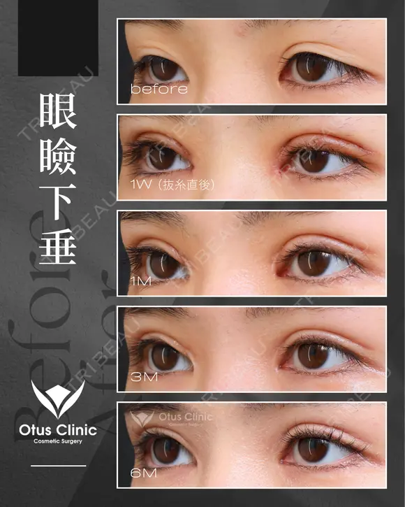 眼瞼下垂 / 目頭切開 before画像 メイン用