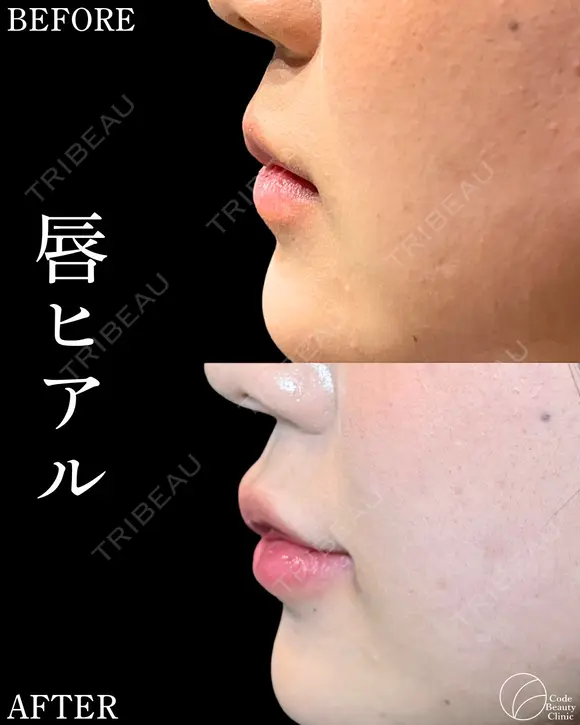 ヒアルロン酸💎チャウムプレミアム💎 after画像 メイン用