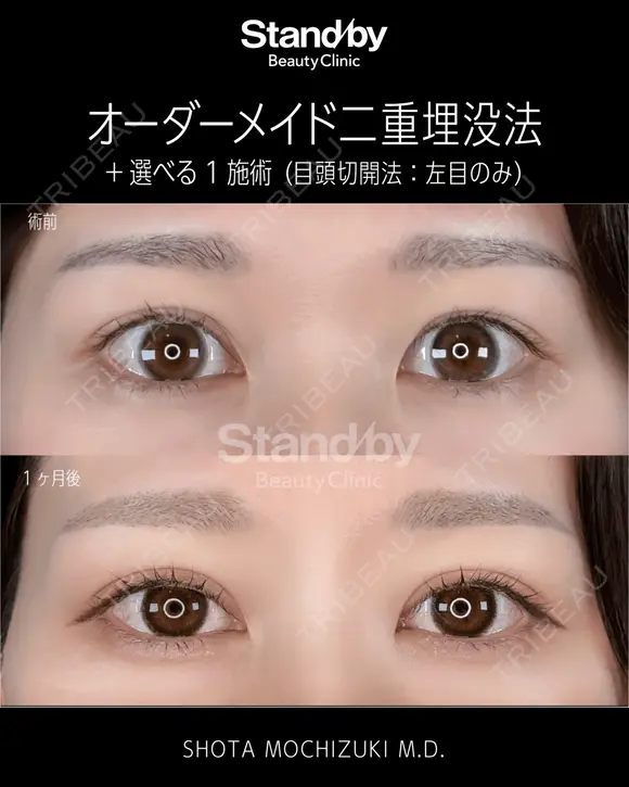 オーダーメイド二重埋没法＋選べる１施術（目頭切開法：左目のみ） before画像 メイン用