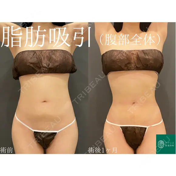 コンプリート脂肪吸引（上下腹部ウエスト腰）自然な範囲でしっかりと吸引🌴 before画像 メイン用