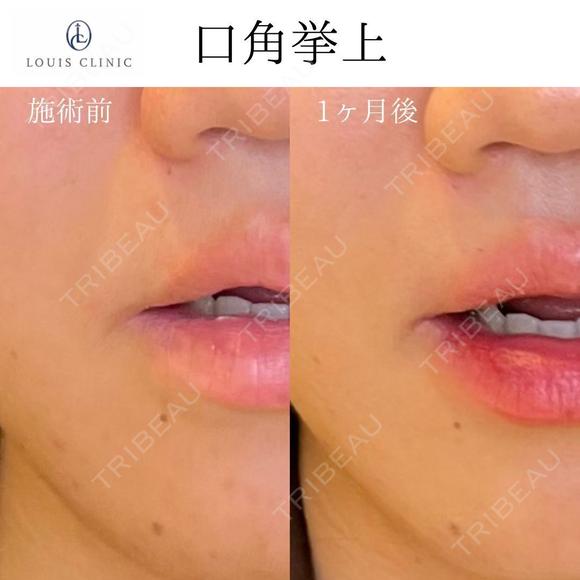 口角挙上 before画像 メイン用