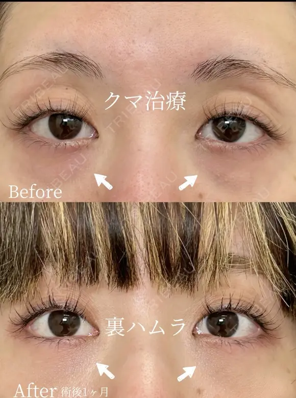 クマ治療　(裏ハムラ法) before画像 メイン用
