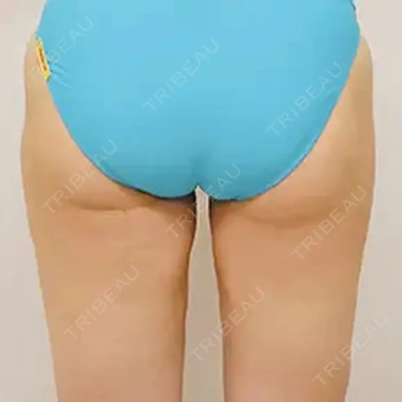 脂肪吸引 after画像 メイン用