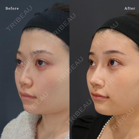 鼻中隔延長・鼻尖形成・鼻骨骨切り幅寄せ・額、こめかみ脂肪注入 before画像 メイン用