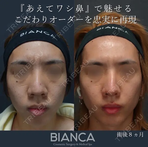 鷲鼻を忠実に再現 after画像 メイン用