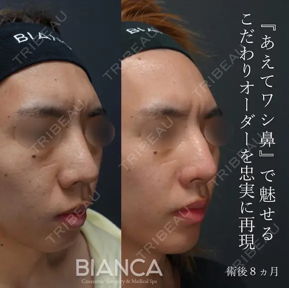 鷲鼻を忠実に再現 after画像 メイン用