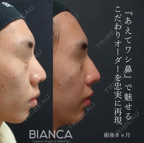 鷲鼻を忠実に再現 after画像 メイン用