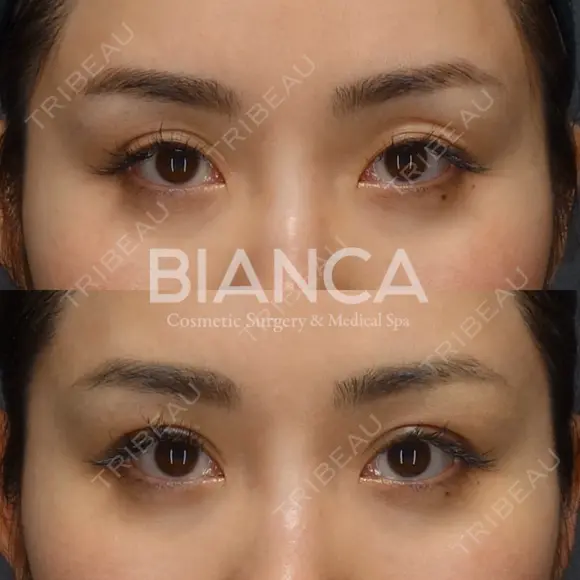 切らない眼瞼下垂（タッキング法） before画像 メイン用