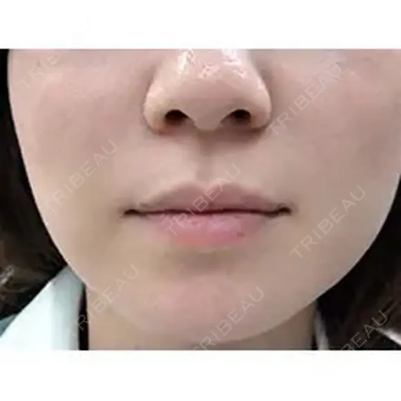 M字リップ形成 before画像 メイン用