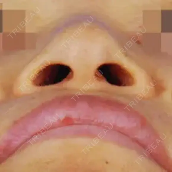 クレオパトラノーズ before画像 メイン用