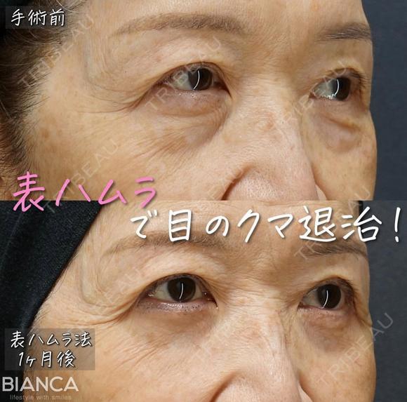 クマ治療（表ハムラ） after画像 メイン用