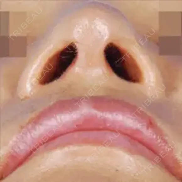 クレオパトラノーズ after画像 メイン用