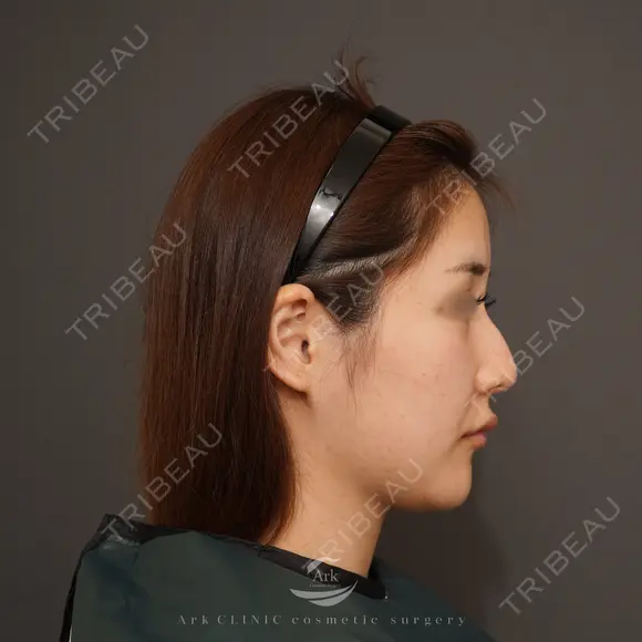 鼻骨骨切り＋ハンプ削り＋鼻中隔延長＋鼻尖形成 (耳介軟骨) before画像 メイン用