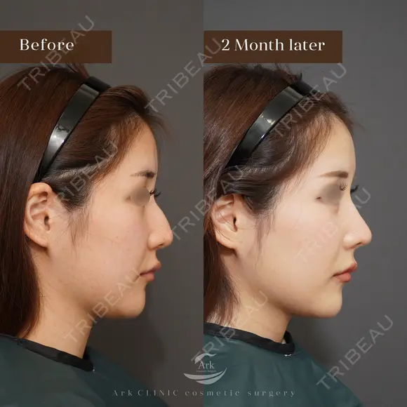 鼻骨骨切り＋ハンプ削り＋鼻中隔延長＋鼻尖形成 (耳介軟骨) after画像 メイン用