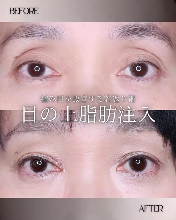 脂肪注入(目の上) before画像 メイン用