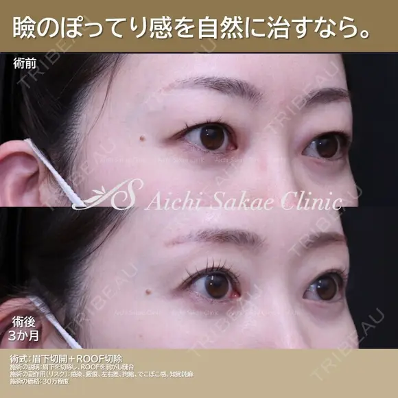 眉下切開、ROOF切除 after画像 メイン用