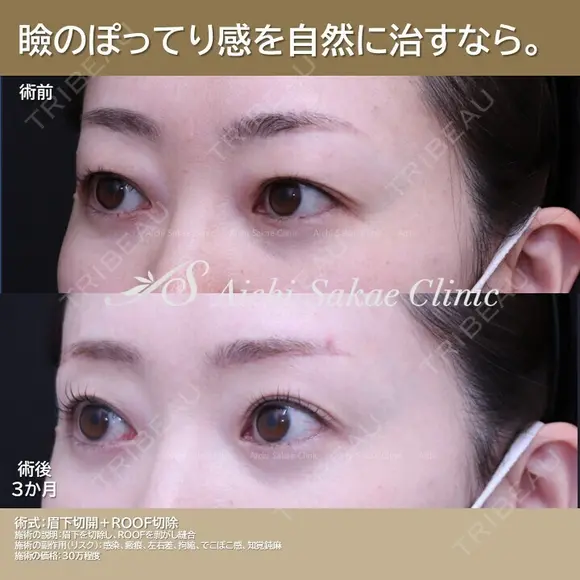 眉下切開、ROOF切除 after画像 メイン用