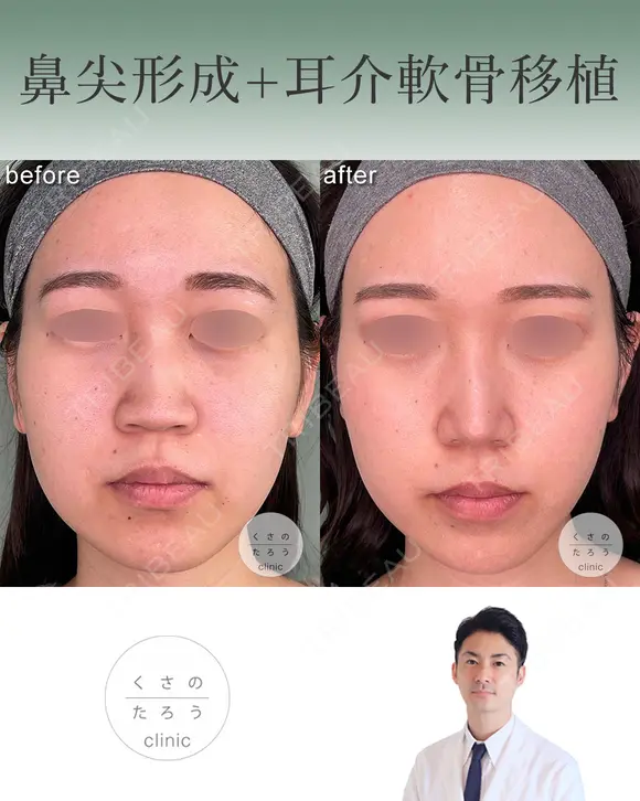 鼻尖形成＋耳介軟骨移植 after画像 メイン用