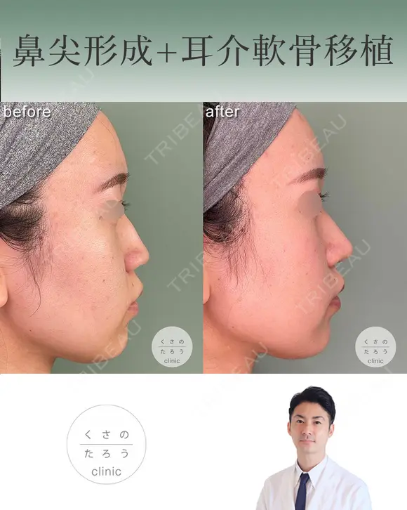 鼻尖形成＋耳介軟骨移植 after画像 メイン用
