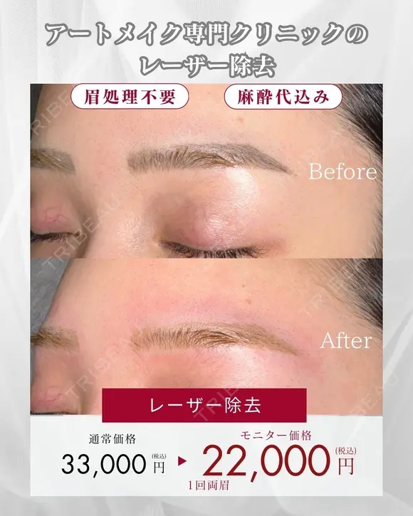 アートメイク除去・トーニング after画像 メイン用