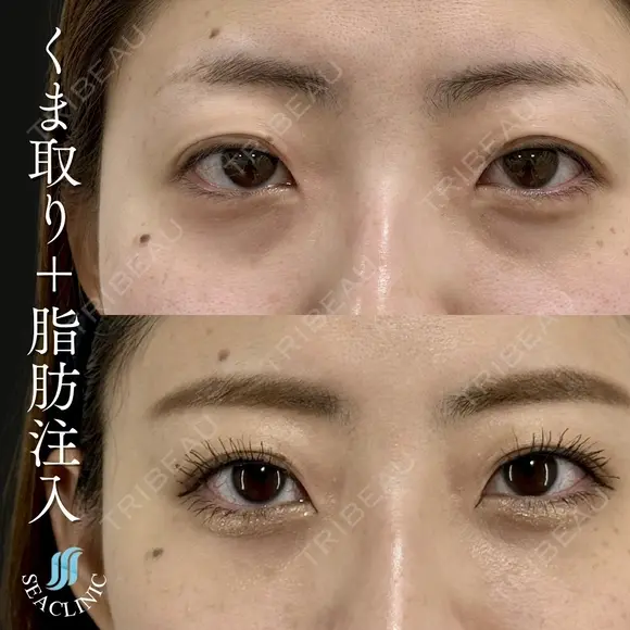 くま取り＋脂肪注入 after画像 メイン用