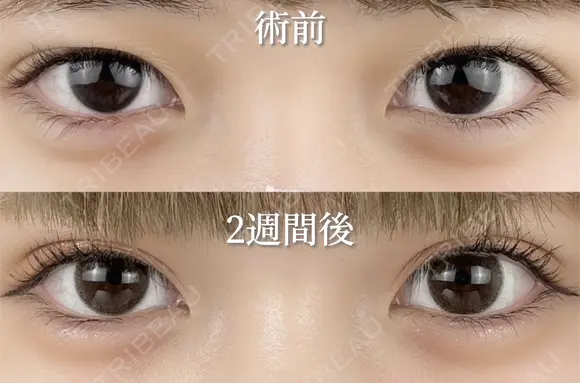 二重埋没法 before画像 メイン用