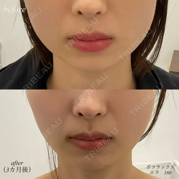 エラボトックス after画像 メイン用