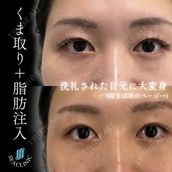 くま取り＋脂肪注入 after画像 メイン用