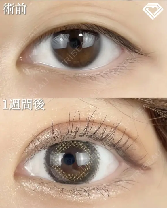 二重埋没法 before画像 メイン用