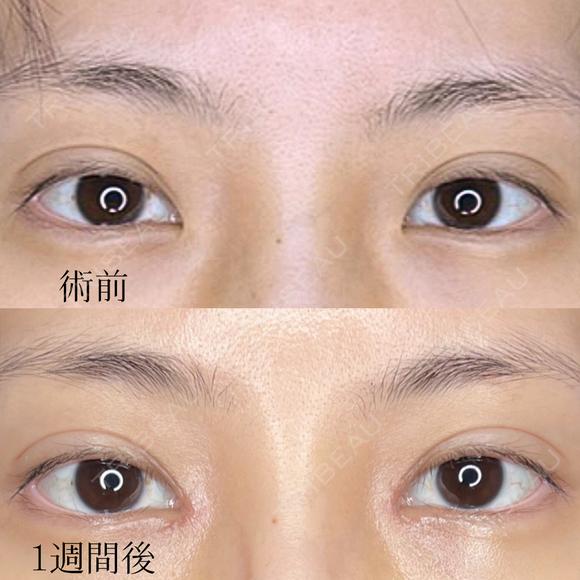 ☘️目頭切開☘️ after画像 メイン用