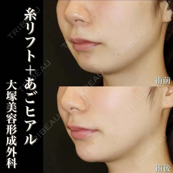 糸リフト+あごヒアルロン酸注入 after画像 メイン用