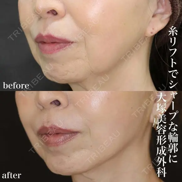 糸リフト after画像 メイン用