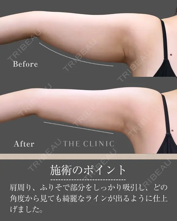 どこから見ても華奢な腕に！｜二の腕のベイザー脂肪吸引 before画像 メイン用