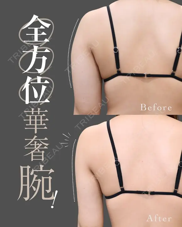 どこから見ても華奢な腕に！｜二の腕のベイザー脂肪吸引 after画像 メイン用