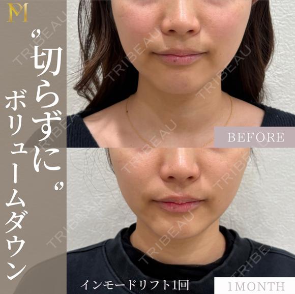 インモードリフト(ミニFx＋フォーマ) before画像 メイン用