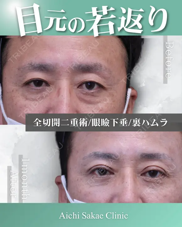 眼瞼下垂、全切開、裏ハムラ before画像 メイン用