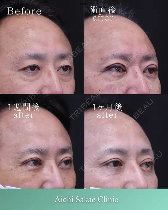 眼瞼下垂、全切開、裏ハムラ after画像 メイン用