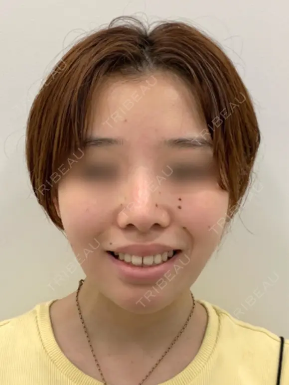脂肪吸引(頬・顎下)/バッカルファット除去/エラボトックス   30日後 メイン用