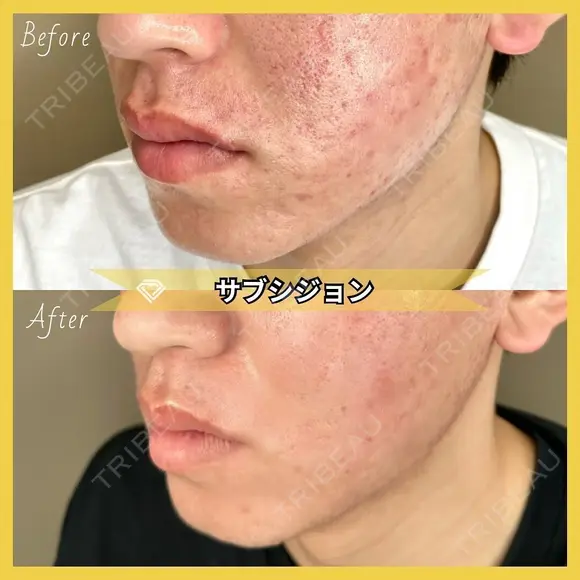 サブシジョン before画像 メイン用