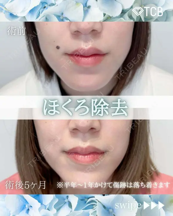 ほくろ除去・いぼ除去 before画像 メイン用