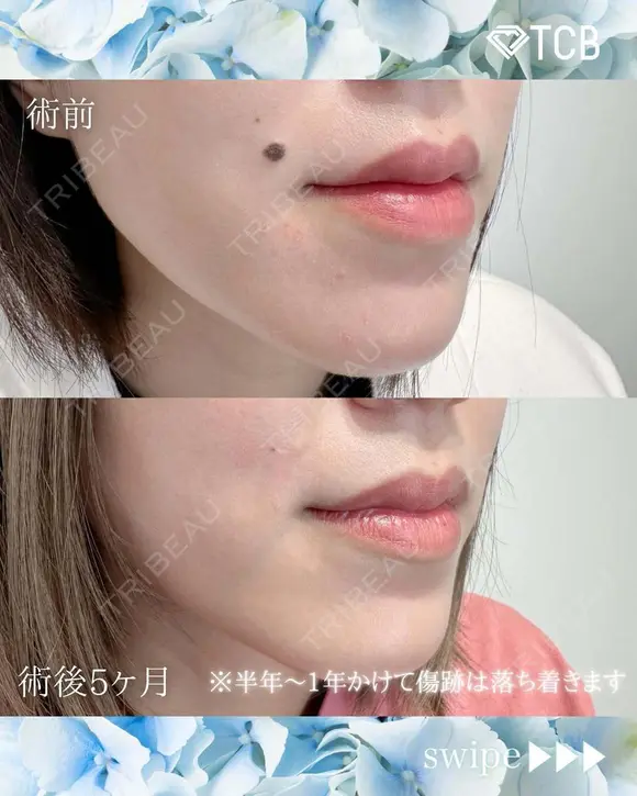 ほくろ除去・いぼ除去 after画像 メイン用