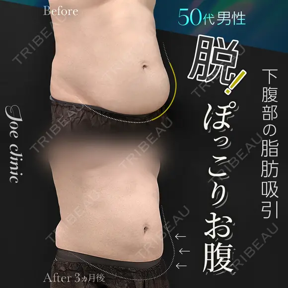 脂肪吸引（下腹部） before画像 メイン用